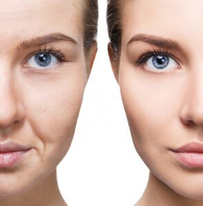 microneedling with exosomes in London - Before-And-After-Skin-Rejuvation